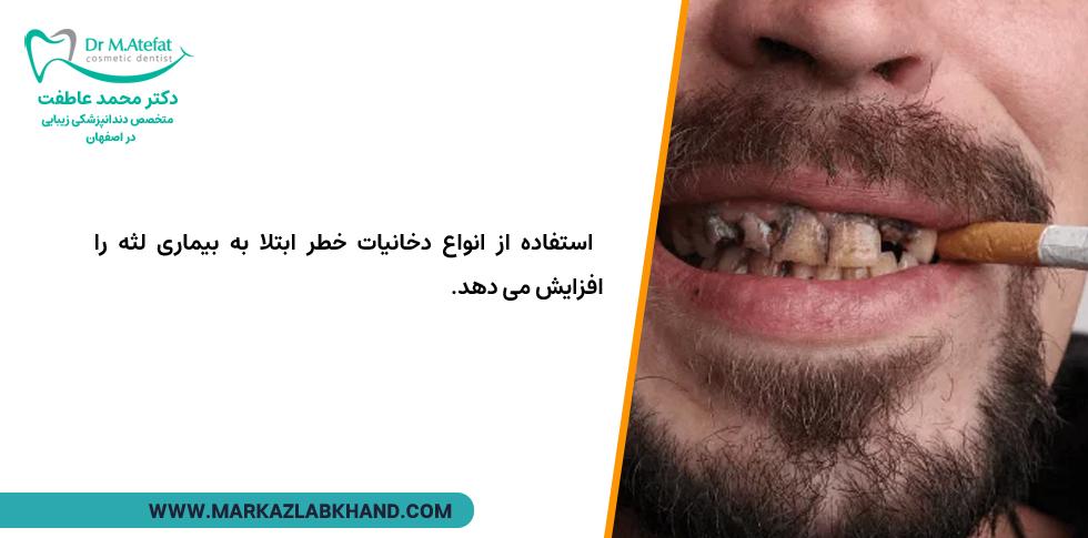 سیگار و بیماری پریودنتال لثه