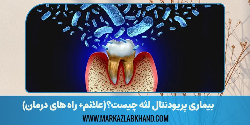 بیماری پریودنتال لثه چیست