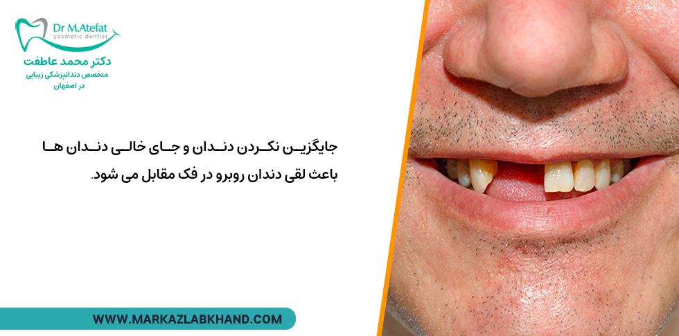 جای خالی دندان باعث لق شدن دندان روبه رو می شود