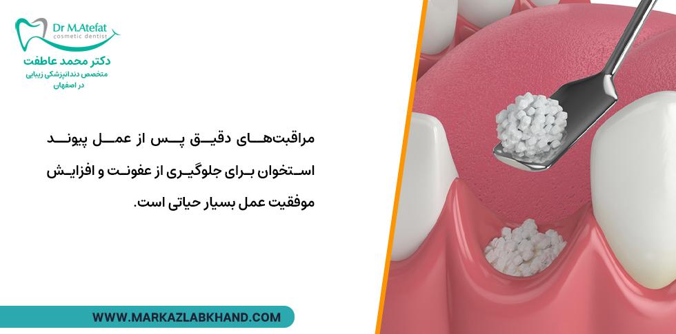 مراقبت های بعد از پیوند استخوان برای ایمپلنت