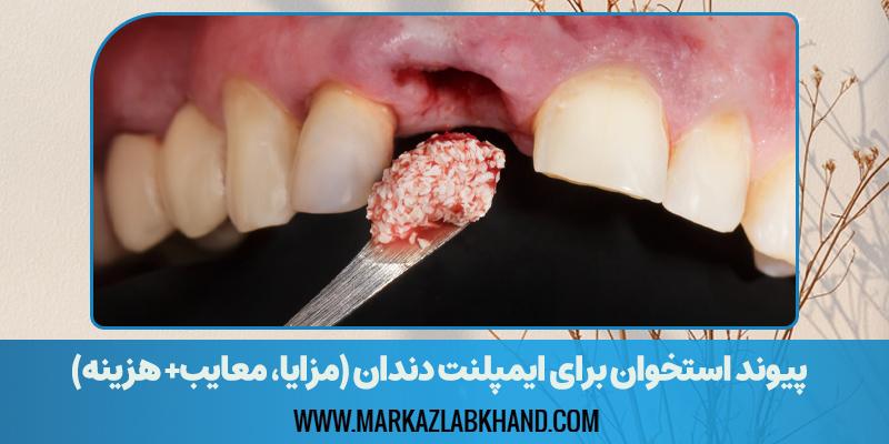 پیوند استخوان برای کاشت ایمپلنت دندان