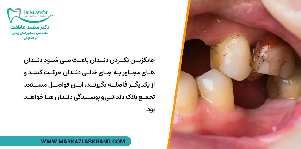 جای خالی دندان ها باعث حرکت دندان های مجاور می شود