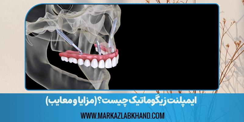 ایمپلنت زیگوماتیک چیست؟