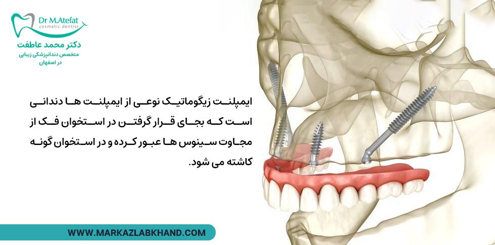 ایمپلنت زیگوماتیک