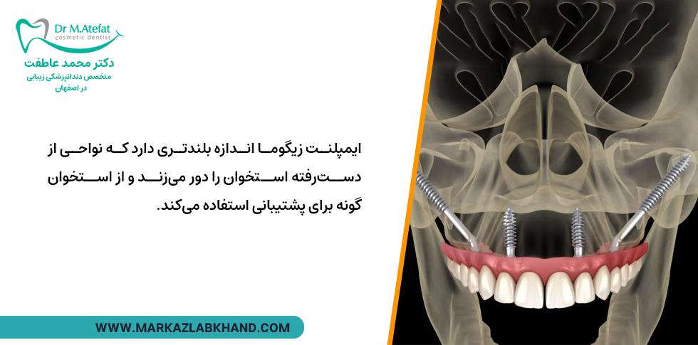 ایمپلنت زیگوماتیک از استخوان گونه برای پشتیبانی استفاده می کند