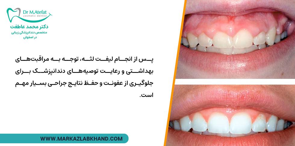 مراقبت بعد از لیفت لثه