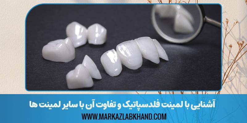 آشنایی با لمینت فلدسپاتیک و تفاوت آن با سایر لمینت ها