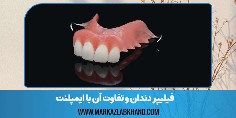 فیلیپر دندان و تفاوت آن با ایمپلنت