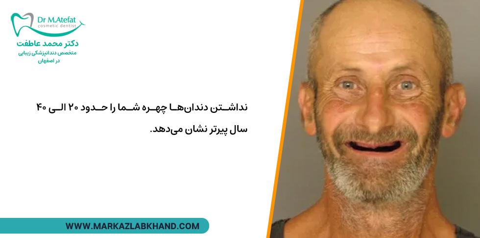 عوارض جای خالی دندان و تاثیر آن بر چهره