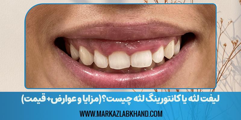 لیفت لثه چیست؟