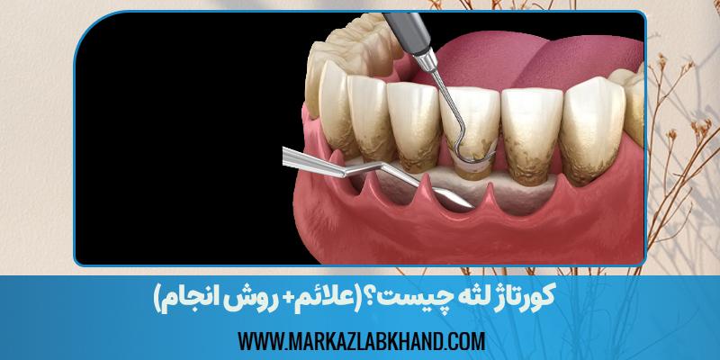 کورتاژ لثه چیست؟(علائم+ روش انجام)