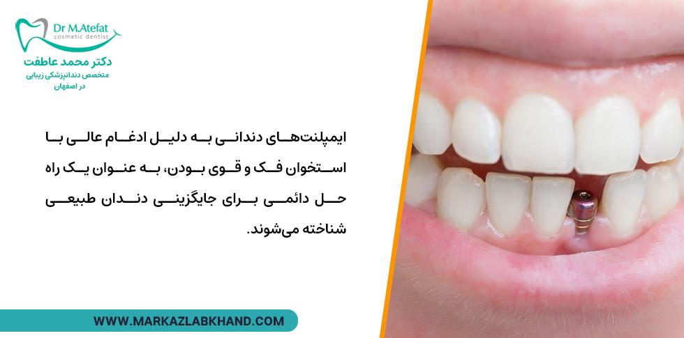 ایمپلنت های دندانی برای پر کردن جای خالی دندان ها