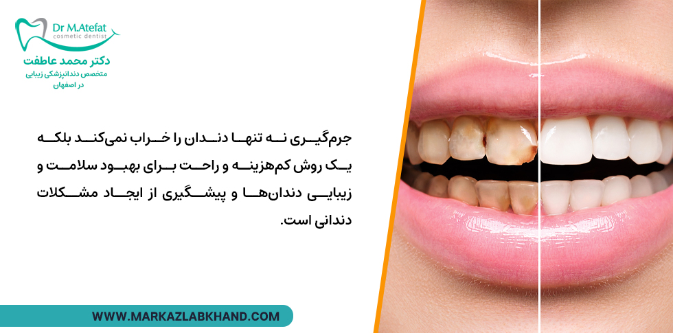 مزایای جرمگیری دندان