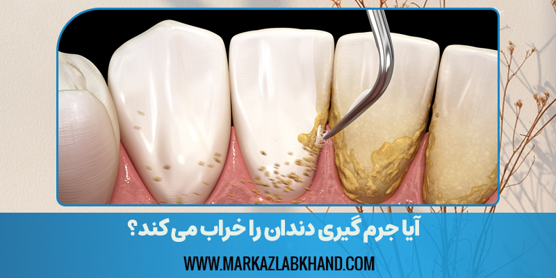 آیا جرم گیری دندان را خراب می کند؟