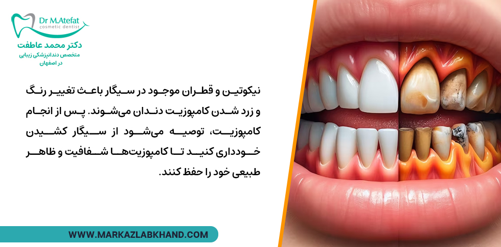 تأثیرات سیگار رسم کردن بر دندان‌های کامپوزیت شده