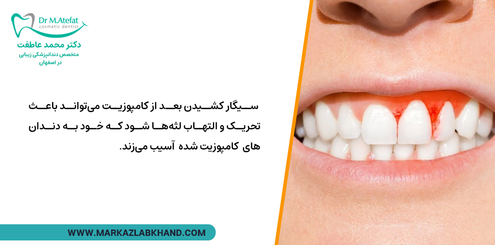 تأثیرات سیگار رسم کردن بر کامپوزیت دندان
