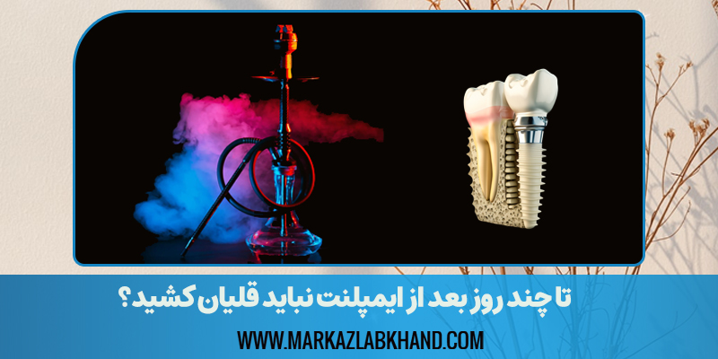 تا چند روز بعد از ایمپلنت نباید قلیان کشید؟