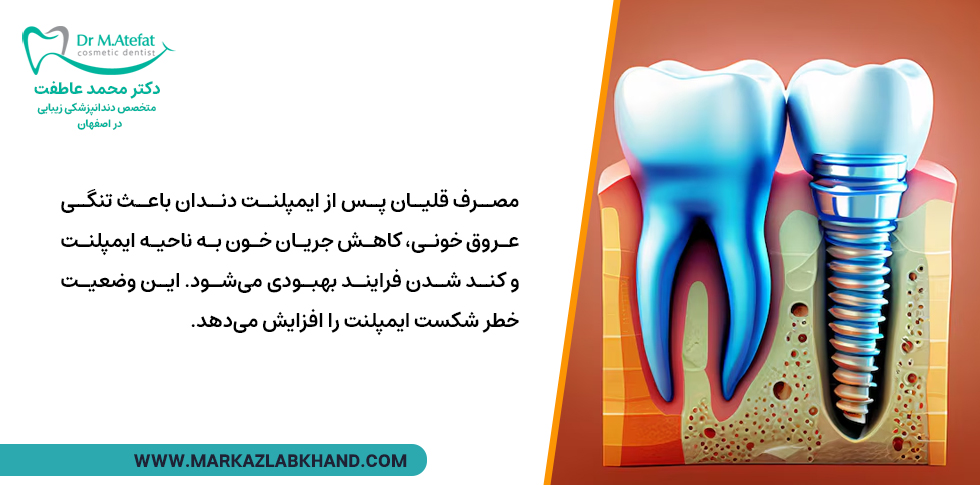 عوارض مصرف قلیان بعد از کاشت ایمپلنت