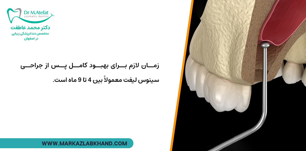 دوران نقاهت بعد از جراحی سینوس لیفت