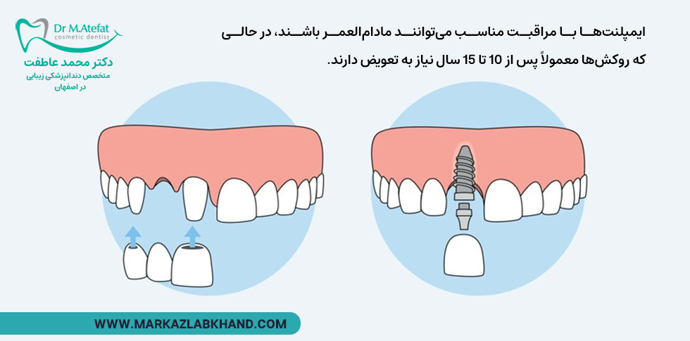 تفاوت روکش و ایمپلنت دندان در طول عمر