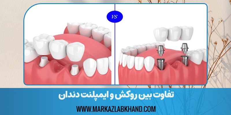 تفاوت روکش و ایمپلنت دندان