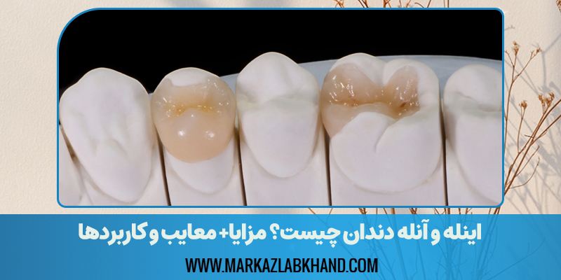 اینله و آنله دندان چیست؟