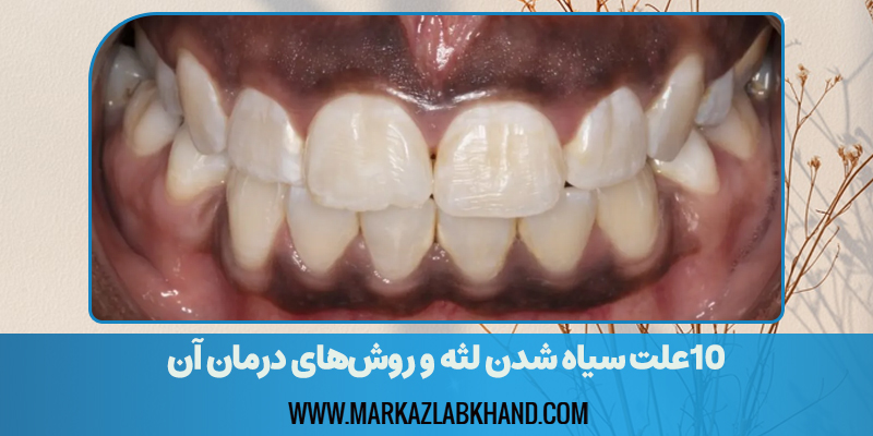 10علت‌ سیاه شدن لثه و روش‌های درمان آن