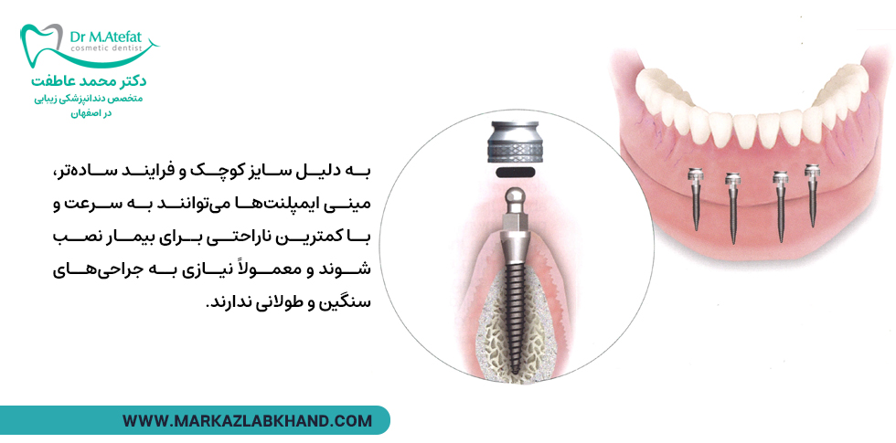 مزایای مینی ایمپلنت ها