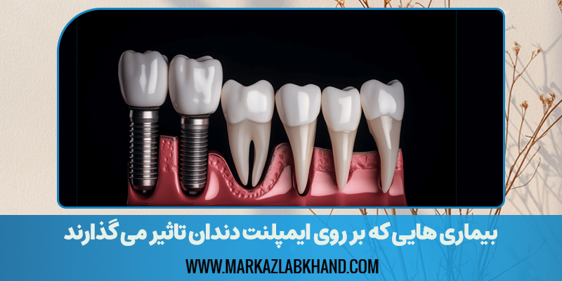 بیماری هایی که بر روی ایمپلنت دندان تاثیر می گذارند