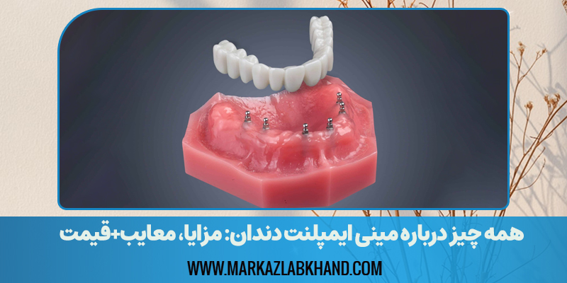 همه چیز درباره مینی ایمپلنت دندان: مزایا، معایب+قیمت