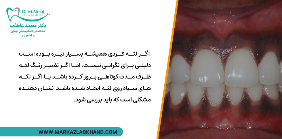 علت سیاه شدن لثه