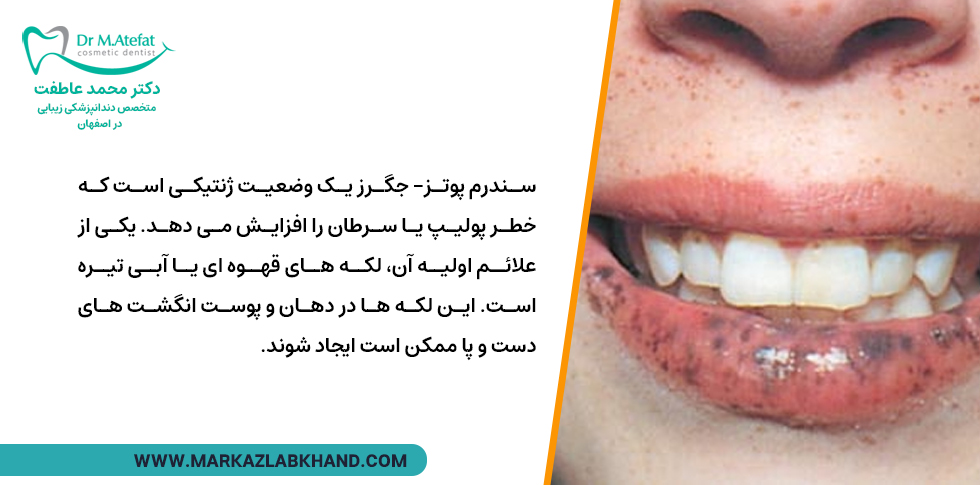 بیماری ژنتیکی سندرم پوتزجگرز و سیاه شدن لثه ها