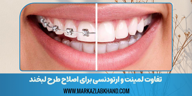 تفاوت لمینت و ارتودنسی برای اصلاح طرح لبخند
