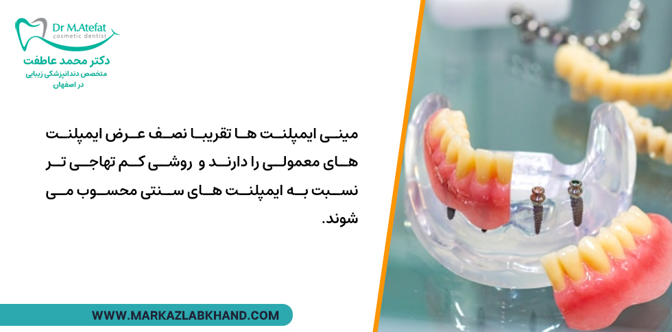 تفاوت مینی ایمپلنت ها و ایمپلنت های معمولی