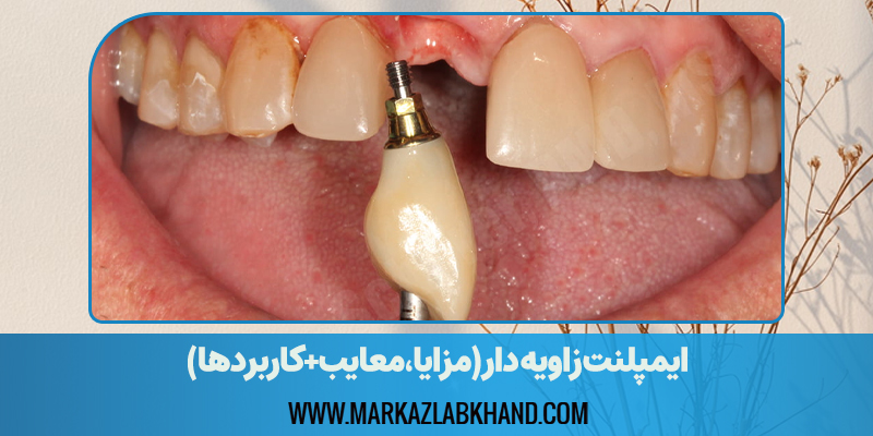 ایمپلنت زاویه دار(مزایا،معایب+کاربردها)