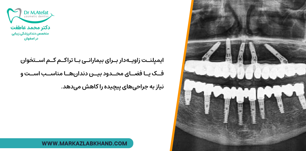 مزایای ایمپلنت زاویه دار