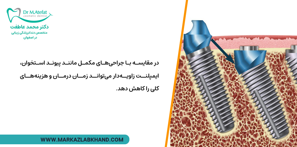 مزیت ایمپلنت زاویه دار نسبت به ایمپلنت معمولی