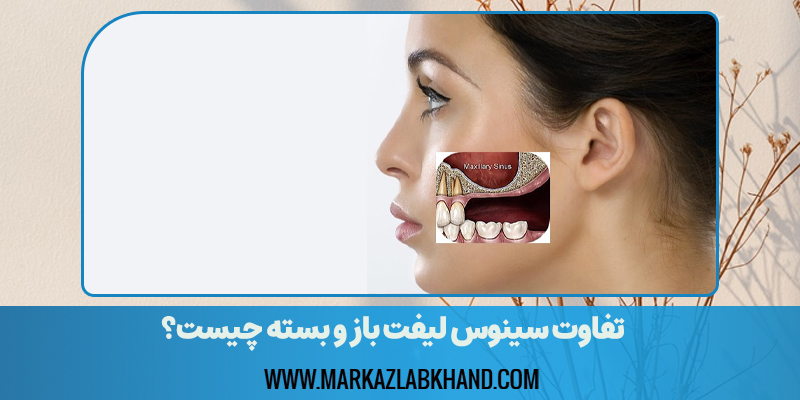 تفاوت سینوس لیفت باز و بسته چیست؟