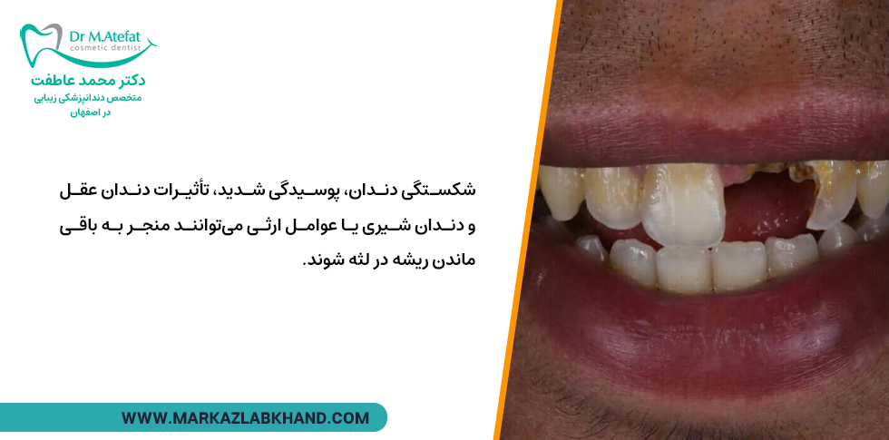 دلایل باقی ماندن ریشه دندان در لثه