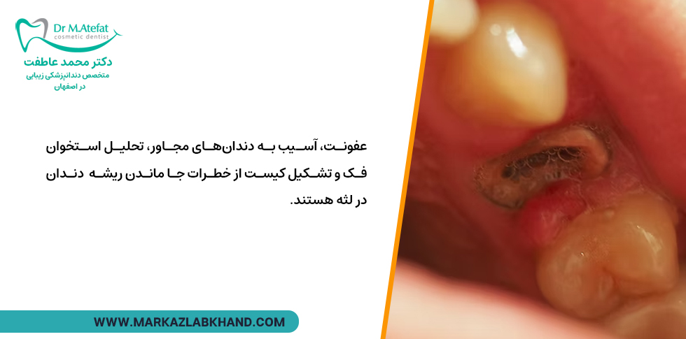 خطرات باقی ماندن ریشه دندان در لثه