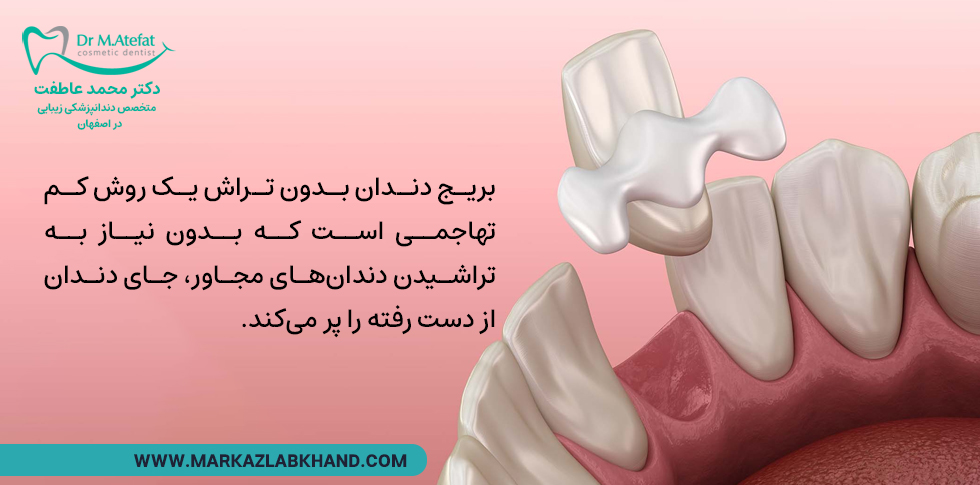 بریج دندان بدون تراش