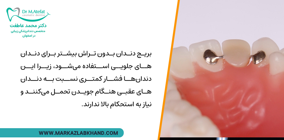 کاربرد بریج دندان بدون تراش