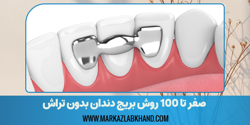 صفر تا 100 روش بریج دندان بدون تراش