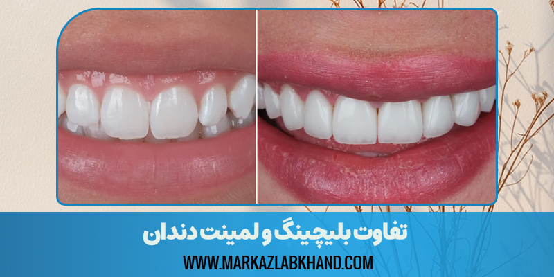تفاوت بلیچینگ و لمینت دندان