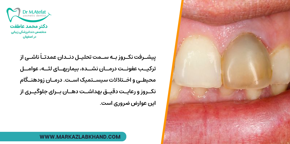 علت ایجاد نکروز پالپ دندان
