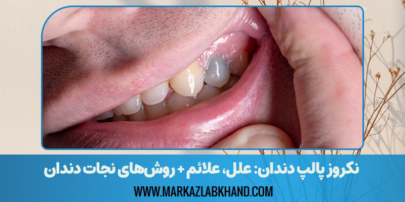نکروز پالپ دندان: علل، علائم و روشهای نجات دندان