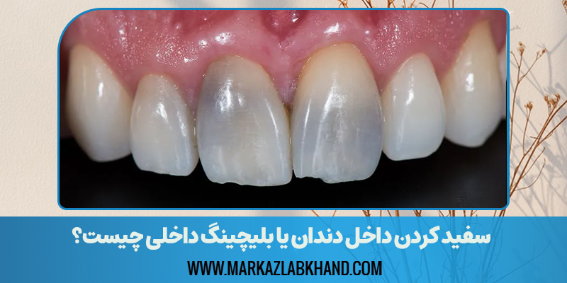 سفید کردن داخل دندان یا بلیچینگ داخلی چیست؟