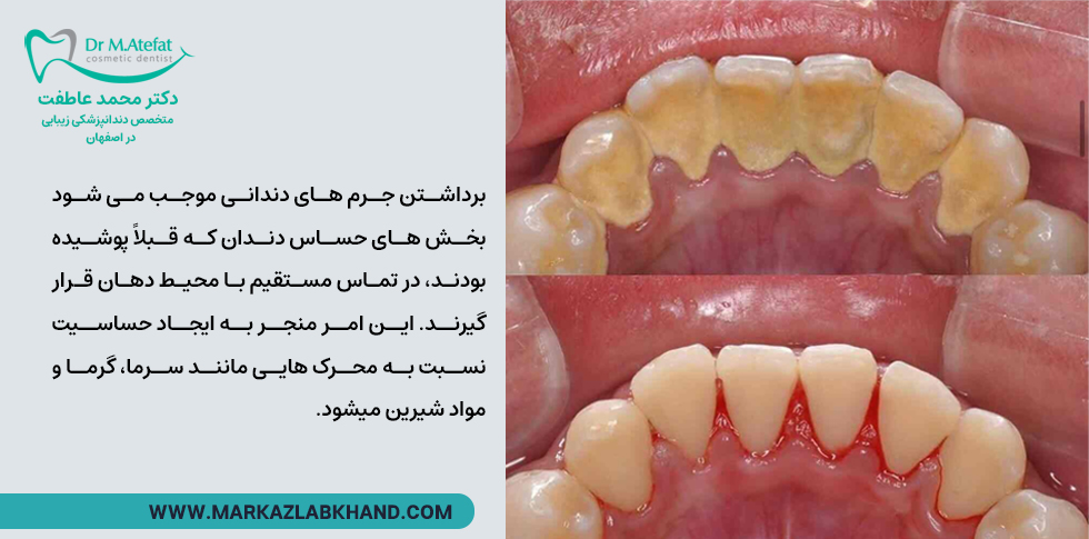 حساس شدن دندان بعد از جرم گیری