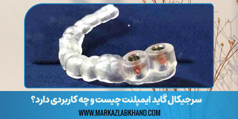 سرجیکال گاید ایمپلنت چیست و چه کاربردی دارد؟