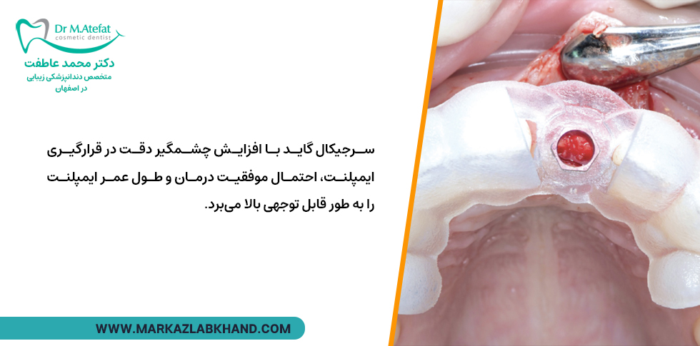 مزایای استفاده از سرجیکال گاید ایمپلنت